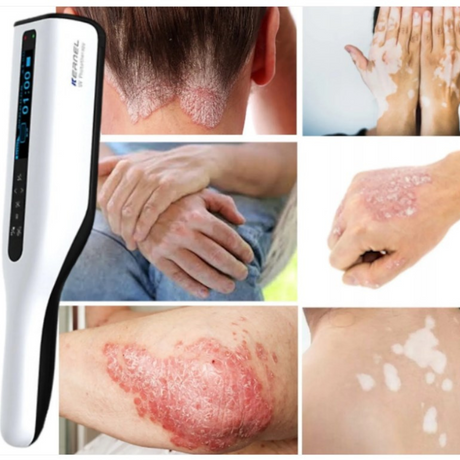 Compact UVB phototherapy device for home use